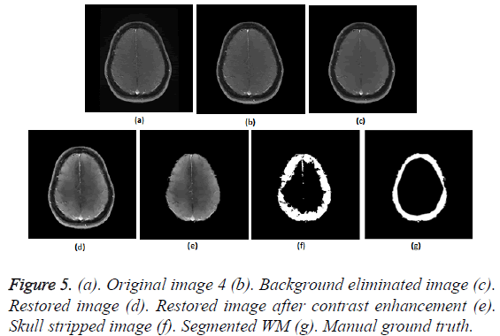 biomedres-Skull-stripped-image