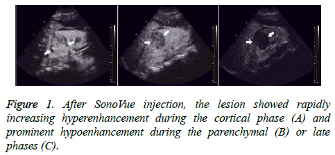 biomedres-SonoVue-injection