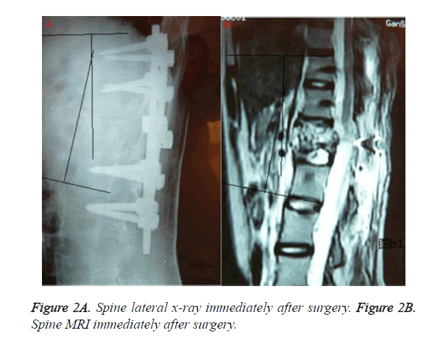 biomedres-Spine-lateral-x-ray-immediately