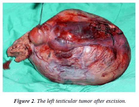 biomedres-The-left-testicular-tumor