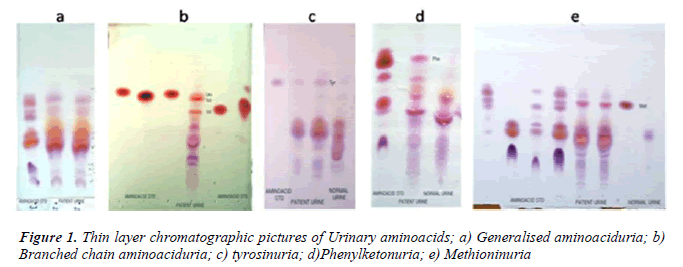 biomedres-Thin-layer-chromatographic-pictures-Urinary-aminoacids