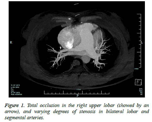 biomedres-Total-occlusion