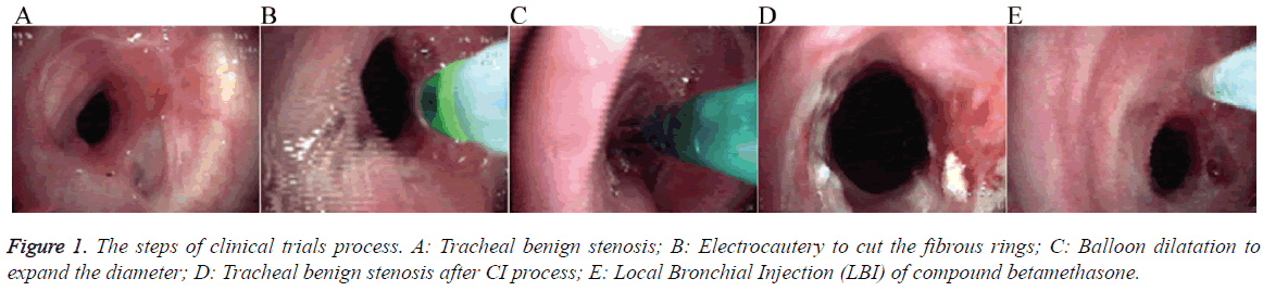 biomedres-Tracheal-benign-stenosis