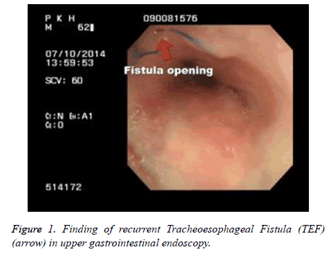 biomedres-Tracheoesophageal-Fistula