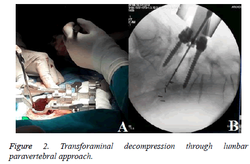 biomedres-Transforaminal-decompression