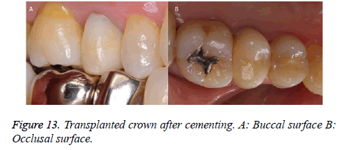 biomedres-Transplanted-crown
