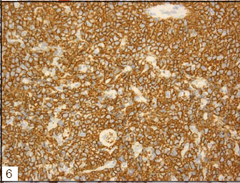 biomedres-Tumor-cells-diffusely