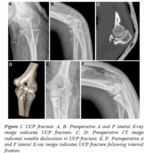 biomedres-UCP-fracture