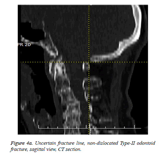 biomedres-Uncertain-fracture