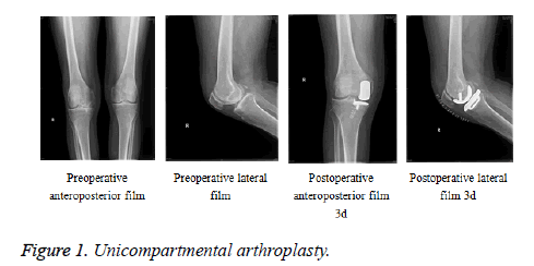 biomedres-Unicompartmental-arthroplasty