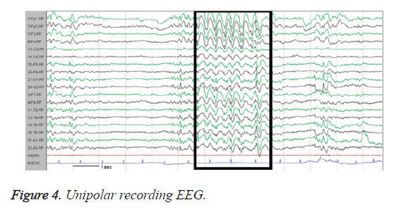 biomedres-Unipolar-recording-EEG