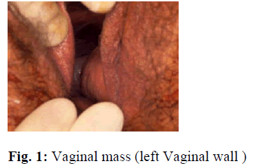 biomedres-Vaginal-mass