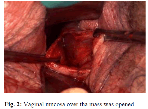 biomedres-Vaginal-mucosa-mass