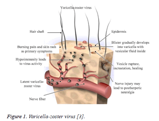 biomedres-Varicella-zoster