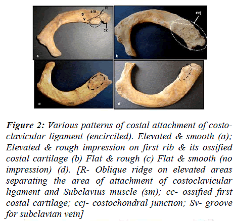 biomedres-Various-patterns-costal-attachment