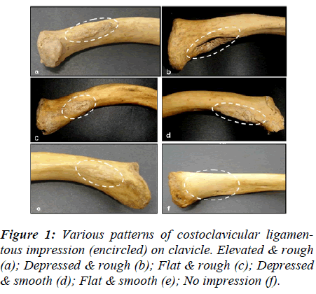 biomedres-Various-patterns-costoclavicular-ligamen-tous