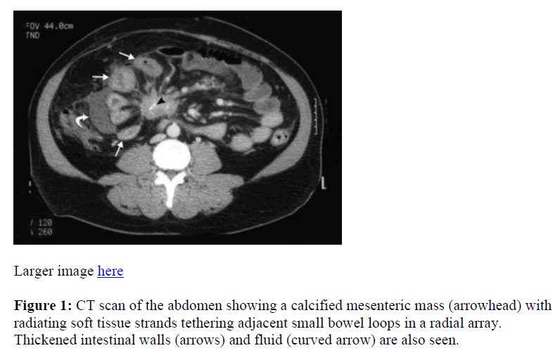 biomedres-abdomen-calcified-mesenteric-mass