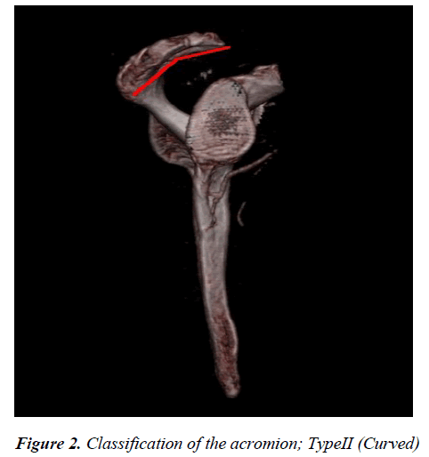 biomedres-acromion-TypeII