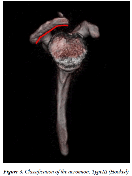 biomedres-acromion-TypeIII