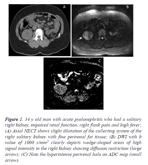 biomedres-acute-pyelonephritis