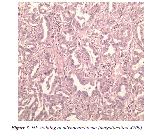 biomedres-adenocarcinoma