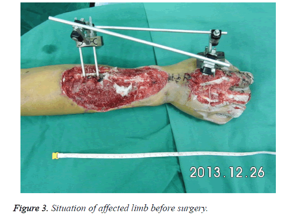 biomedres-affected-limb