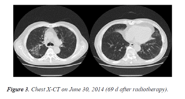 biomedres-after-radiotherapy