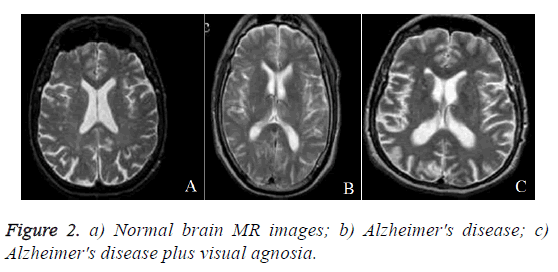 biomedres-alzheimers-disease