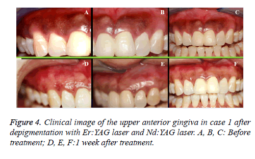 biomedres-anterior-gingiva