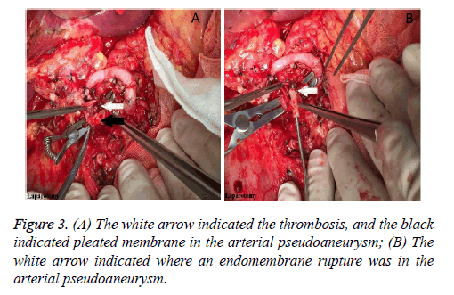 biomedres-arterial-pseudoaneurysm