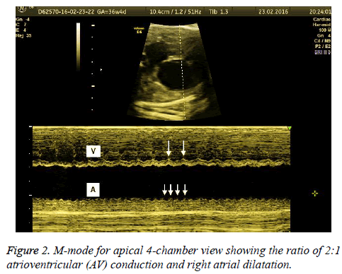 biomedres-atrial-dilatation