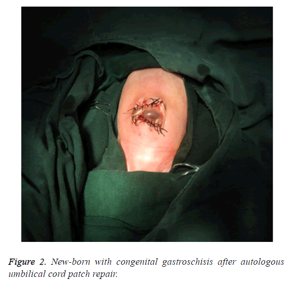 biomedres-autologous-umbilical-cord