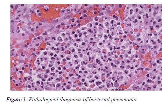 biomedres-bacterial-pneumonia