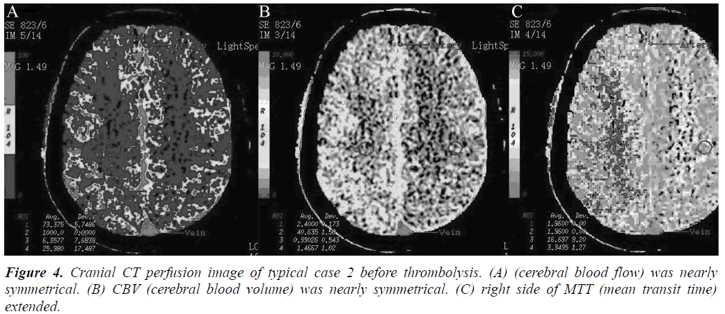 biomedres-before-thrombolysis