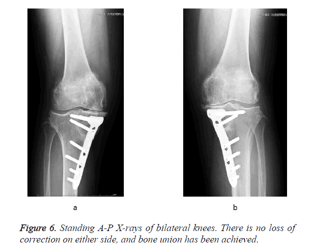 biomedres-bilateral-knees