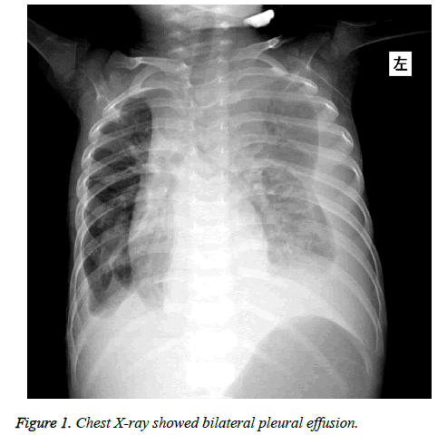 biomedres-bilateral-pleural