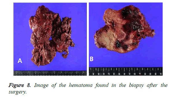 biomedres-biopsy-hematoma