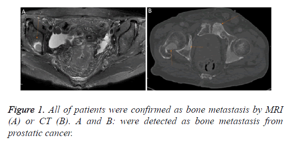 biomedres-bone-metastasis