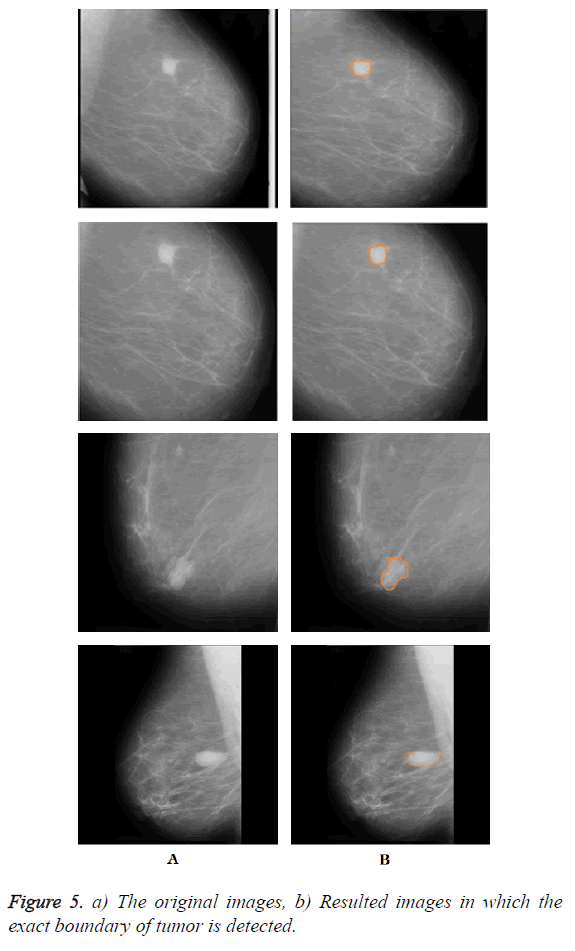 biomedres-boundary-tumor