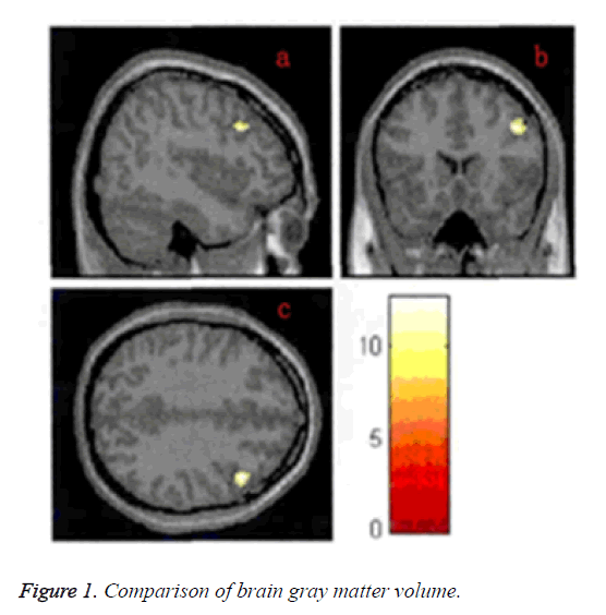 biomedres-brain-gray-matter-volume