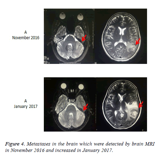 biomedres-brain-nodules