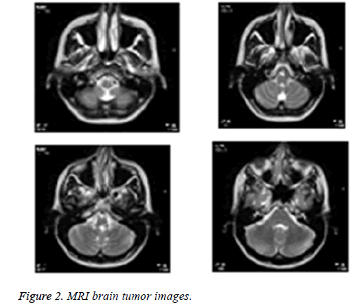 biomedres-brain-tumor