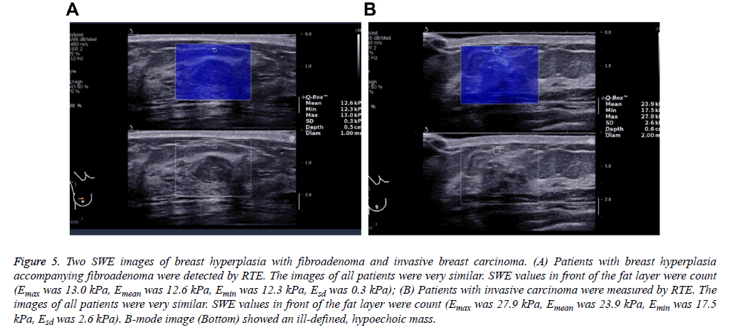 biomedres-breast-hyperplasia