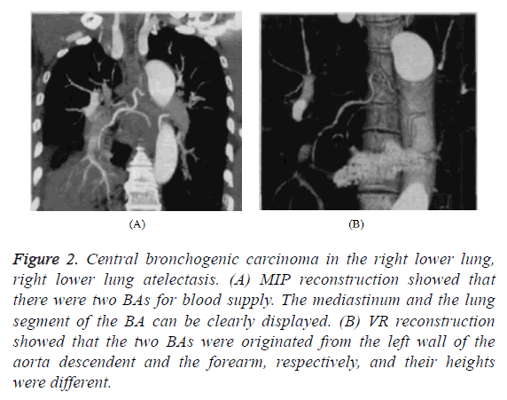 biomedres-bronchogenic-carcinoma