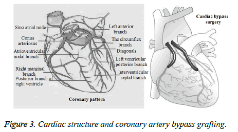 biomedres-bypass-grafting