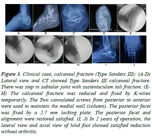 biomedres-calcaneal-fracture