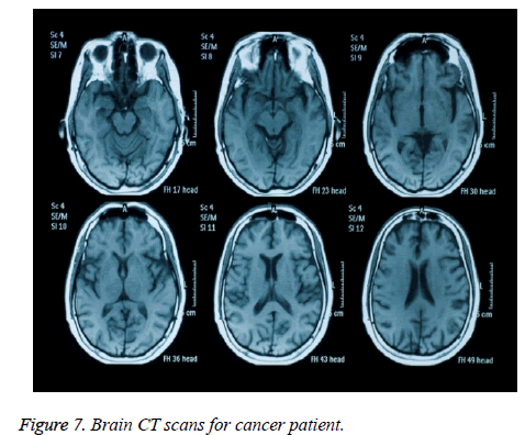 biomedres-cancer-patient