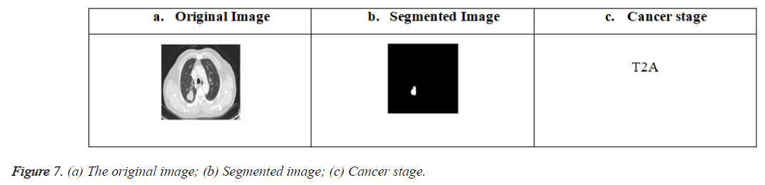 biomedres-cancer-stage