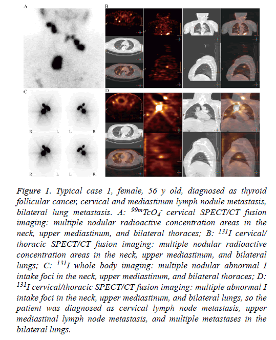 biomedres-cancer-thyroid