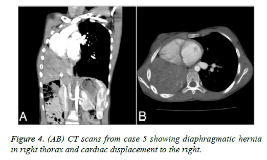 biomedres-cardiac-displacement